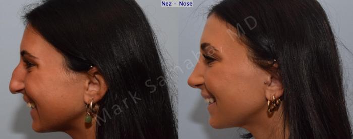 Before & After Rhinoplastie / Rhinoplasty Case 185 Left Side Smile View in Montreal, QC