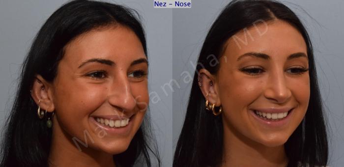 Before & After Rhinoplastie / Rhinoplasty Case 185 Right Oblique Smile View in Montreal, QC
