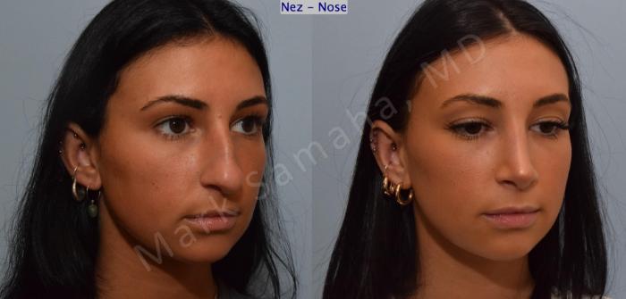 Before & After Rhinoplastie / Rhinoplasty Case 185 Right Oblique View in Montreal, QC