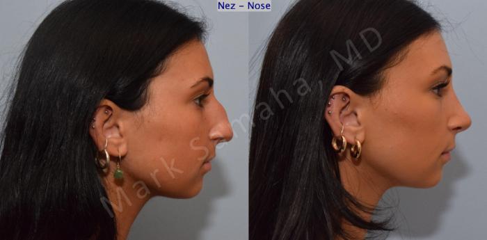 Before & After Rhinoplastie / Rhinoplasty Case 185 Right Side View in Montreal, QC