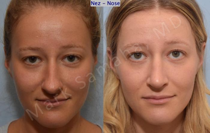 Before & After Rhinoplastie / Rhinoplasty Case 186 Front View in Montreal, QC