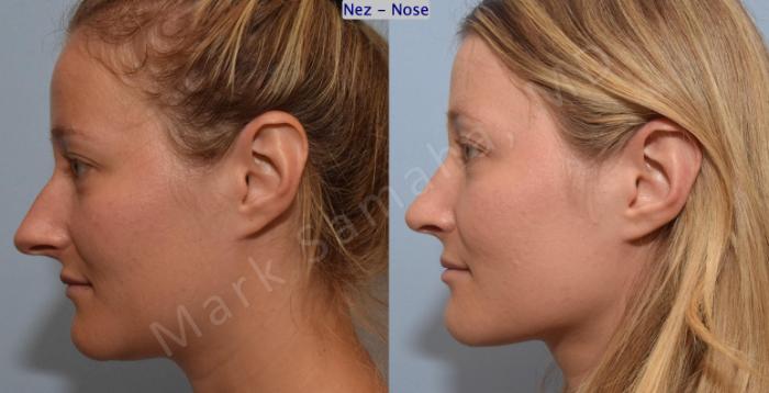 Before & After Rhinoplastie / Rhinoplasty Case 186 Left Side View in Montreal, QC