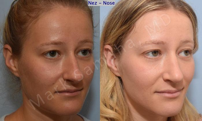 Before & After Rhinoplastie / Rhinoplasty Case 186 Right Oblique View in Montreal, QC