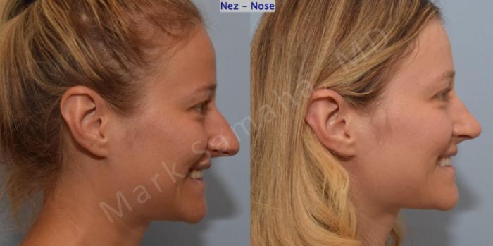 Before & After Rhinoplastie / Rhinoplasty Case 186 Right Side Smile View in Montreal, QC