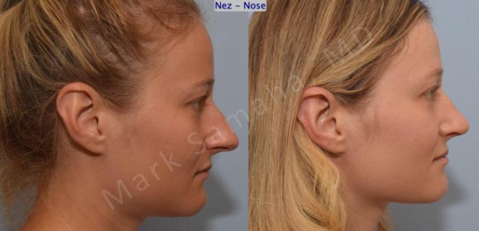 Before & After Rhinoplastie / Rhinoplasty Case 186 Right Side View in Montreal, QC