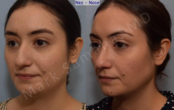 Before & After Rhinoplastie / Rhinoplasty Case 187 Left Oblique View in Montreal, QC