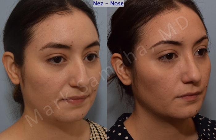 Before & After Rhinoplastie / Rhinoplasty Case 187 Right Oblique View in Montreal, QC