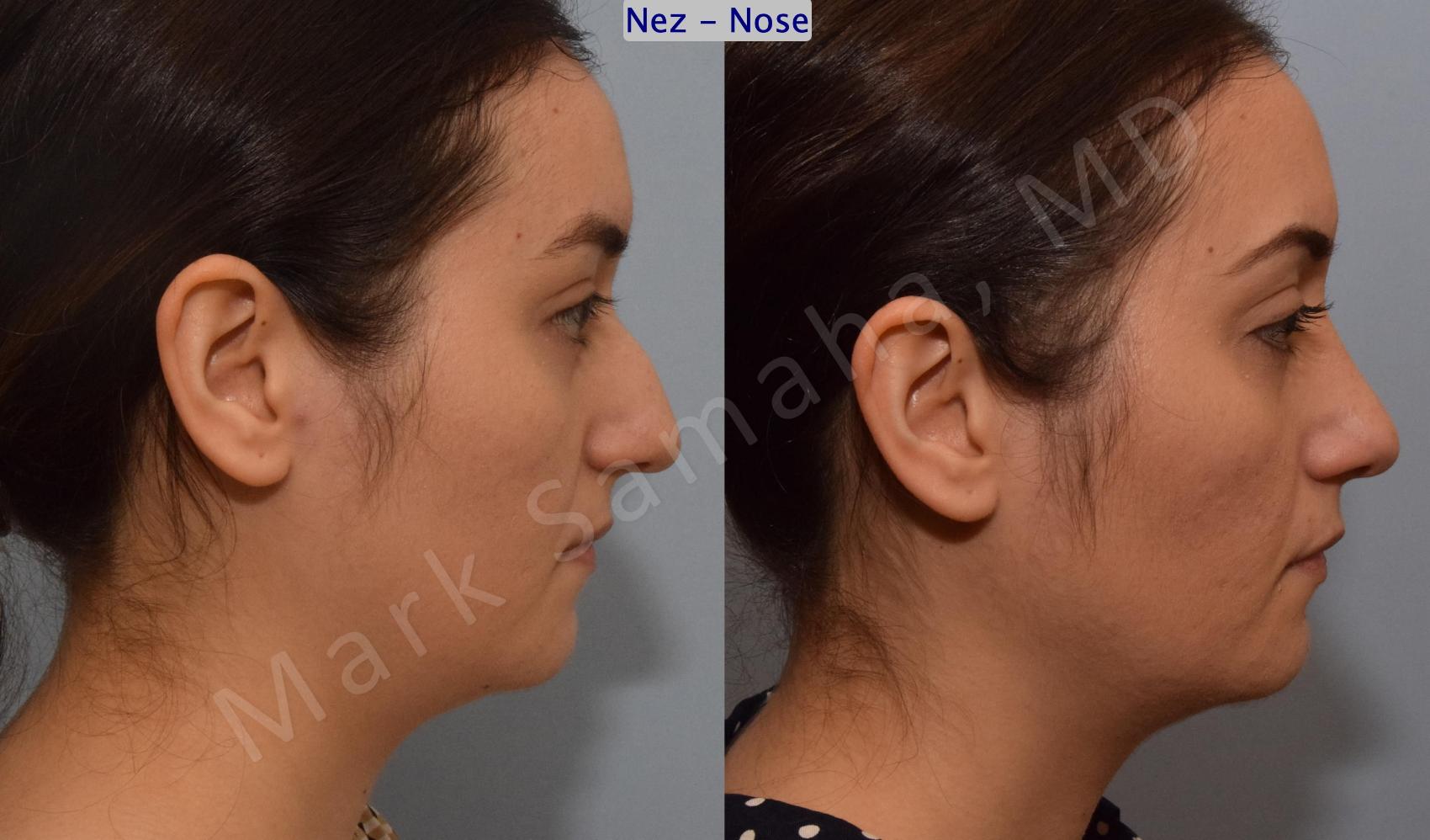 Before & After Rhinoplastie / Rhinoplasty Case 187 Right Side View in Montreal, QC