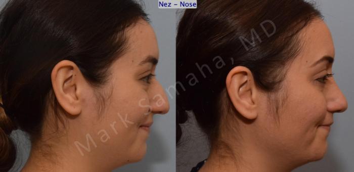 Before & After Rhinoplastie / Rhinoplasty Case 187 Right Side Smile View in Montreal, QC