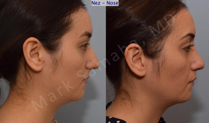 Before & After Rhinoplastie / Rhinoplasty Case 187 Right Side View in Montreal, QC