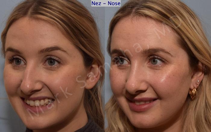 Before & After Rhinoplastie / Rhinoplasty Case 188 Left Oblique Smile View in Montreal, QC