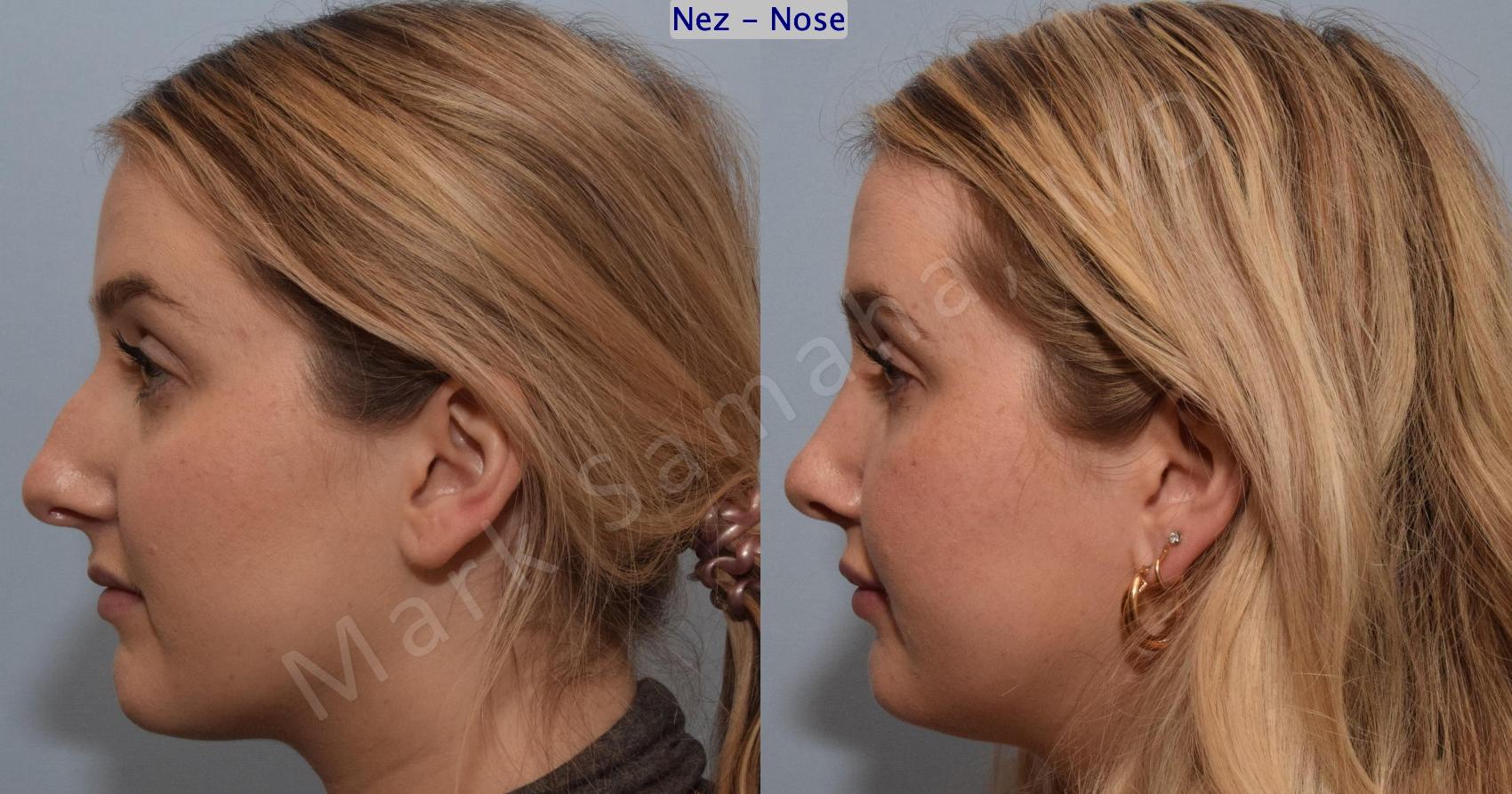 Before & After Rhinoplastie / Rhinoplasty Case 188 Left Side View in Montreal, QC