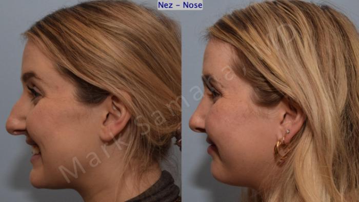 Before & After Rhinoplastie / Rhinoplasty Case 188 Left Side Smile View in Montreal, QC