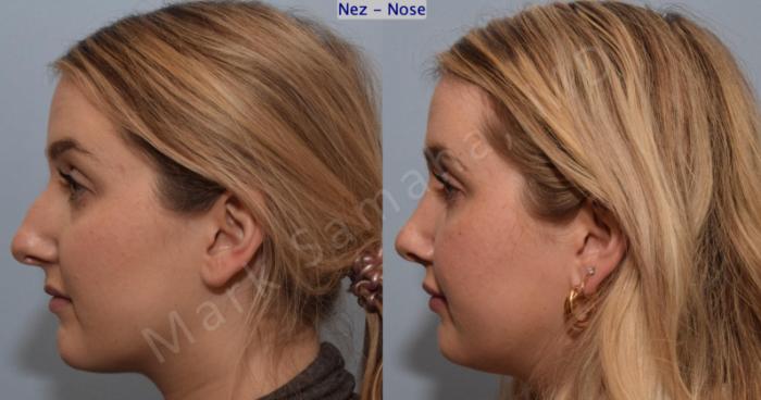 Before & After Rhinoplastie / Rhinoplasty Case 188 Left Side View in Mount Royal, QC
