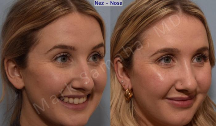 Before & After Rhinoplastie / Rhinoplasty Case 188 Right Oblique Smile View in Montreal, QC