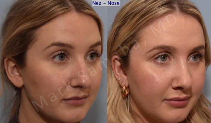 Before & After Rhinoplastie / Rhinoplasty Case 188 Right Oblique View in Montreal, QC