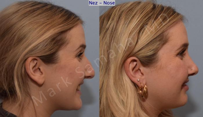 Before & After Rhinoplastie / Rhinoplasty Case 188 Right Side Smile View in Montreal, QC