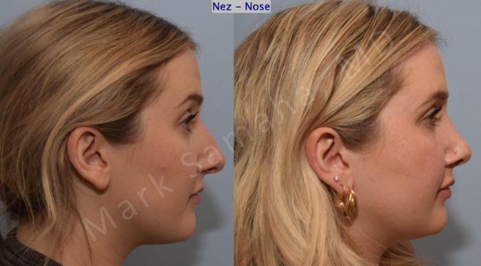 Before & After Rhinoplastie / Rhinoplasty Case 188 Right Side View in Montreal, QC