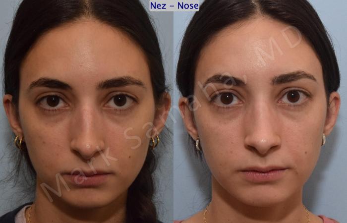 Before & After Rhinoplastie / Rhinoplasty Case 189 Front View in Montreal, QC