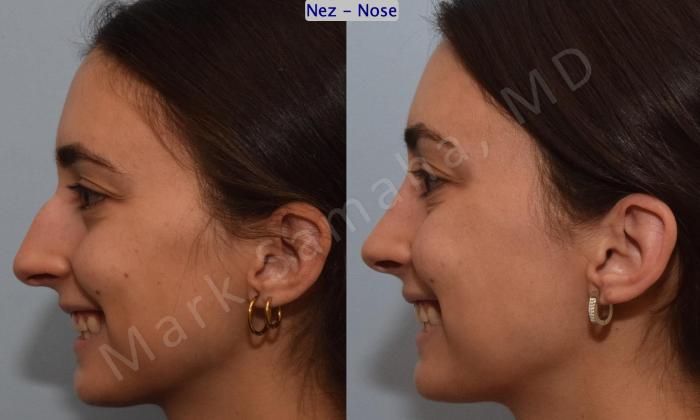 Before & After Rhinoplastie / Rhinoplasty Case 189 Left Side Smile View in Montreal, QC