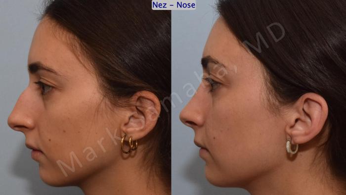 Before & After Rhinoplastie / Rhinoplasty Case 189 Left Side View in Montreal, QC