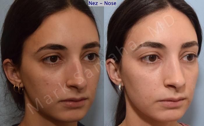Before & After Rhinoplastie / Rhinoplasty Case 189 Right Oblique View in Montreal, QC