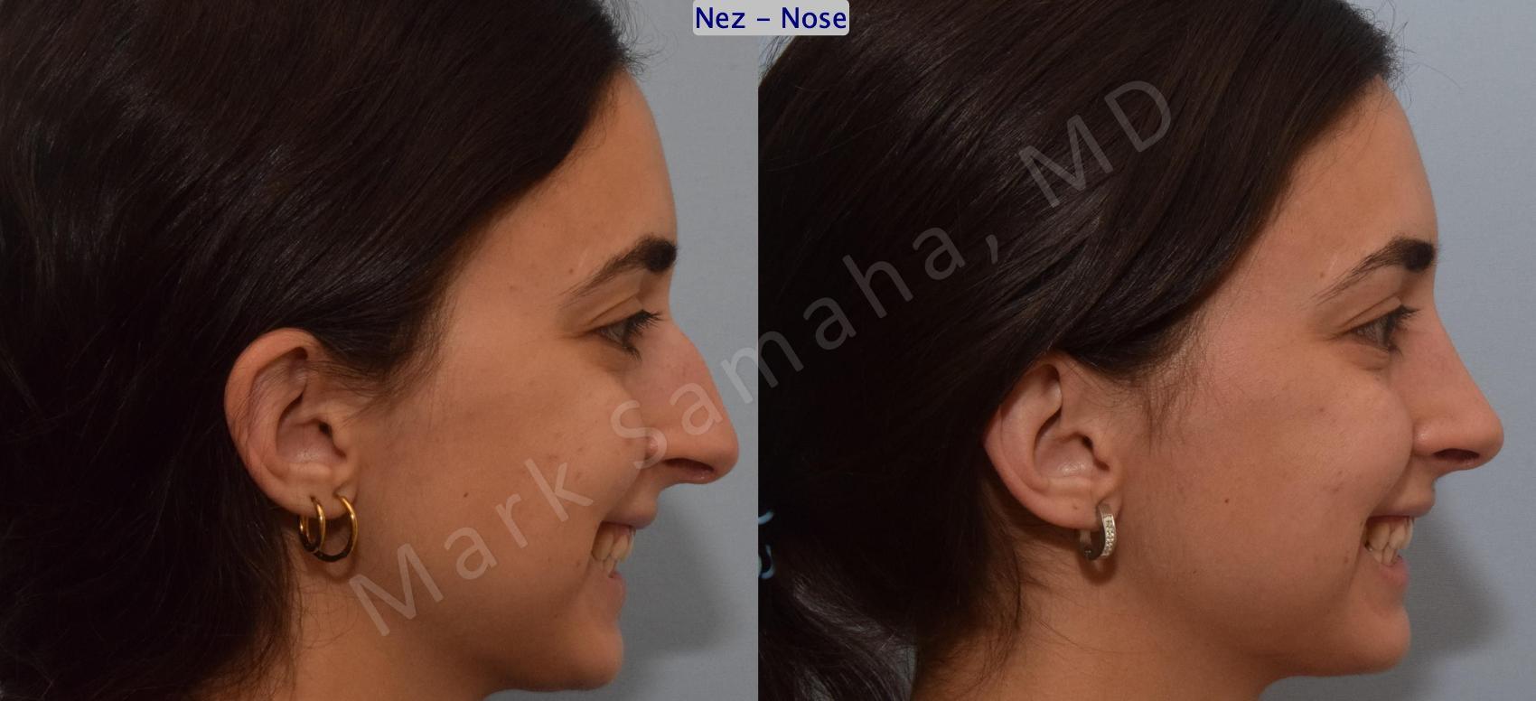 Before & After Rhinoplastie / Rhinoplasty Case 189 Right Side Smile View in Montreal, QC
