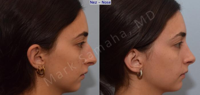 Before & After Rhinoplastie / Rhinoplasty Case 189 Right Side View in Montreal, QC