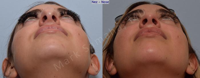 Before & After Rhinoplastie / Rhinoplasty Case 190 Basal View in Montreal, QC