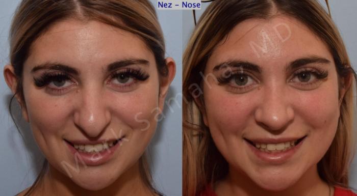 Before & After Rhinoplastie / Rhinoplasty Case 190 Front Smile View in Mount Royal, QC