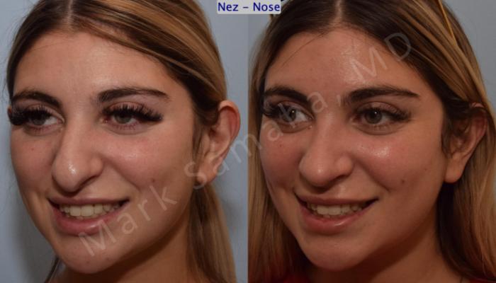 Before & After Rhinoplastie / Rhinoplasty Case 190 Left Oblique Smile View in Montreal, QC