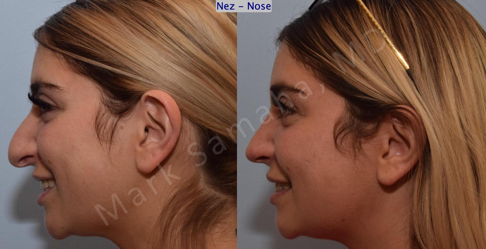Before & After Rhinoplastie / Rhinoplasty Case 190 Left Side Smile View in Montreal, QC