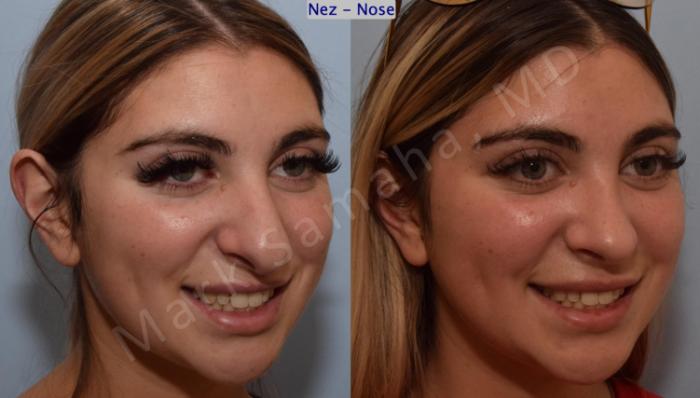 Before & After Rhinoplastie / Rhinoplasty Case 190 Right Oblique Smile View in Montreal, QC