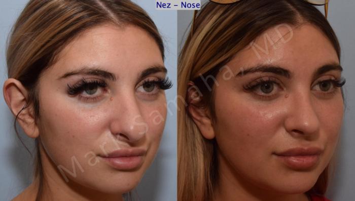 Before & After Rhinoplastie / Rhinoplasty Case 190 Right Oblique View in Montreal, QC
