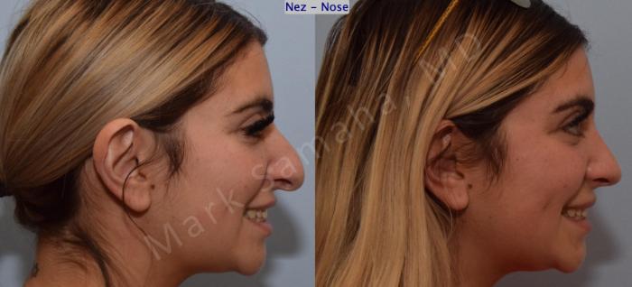 Before & After Rhinoplastie / Rhinoplasty Case 190 Right Side Smile View in Montreal, QC