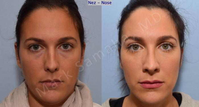 Before & After Rhinoplastie / Rhinoplasty Case 191 Front View in Montreal, QC