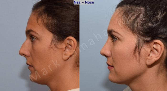 Before & After Rhinoplastie / Rhinoplasty Case 191 Left Side View in Montreal, QC