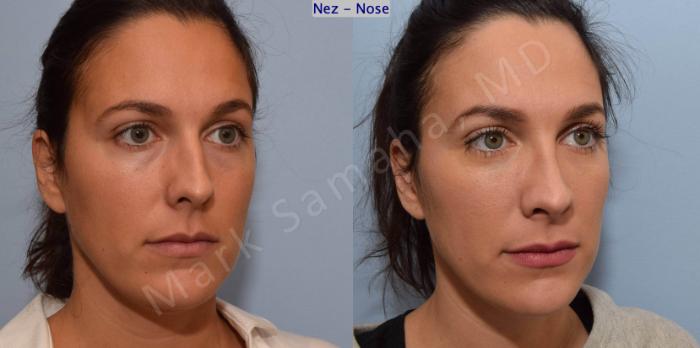 Before & After Rhinoplastie / Rhinoplasty Case 191 Right Oblique View in Montreal, QC