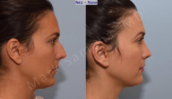 Before & After Rhinoplastie / Rhinoplasty Case 191 Right Side View in Montreal, QC