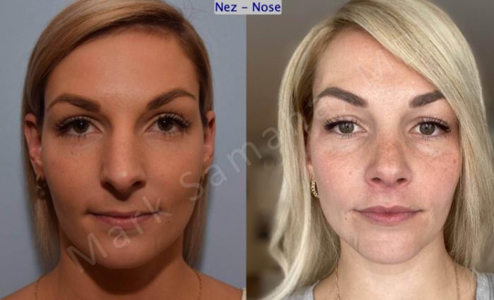 Before & After Rhinoplastie / Rhinoplasty Case 192 Front View in Montreal, QC