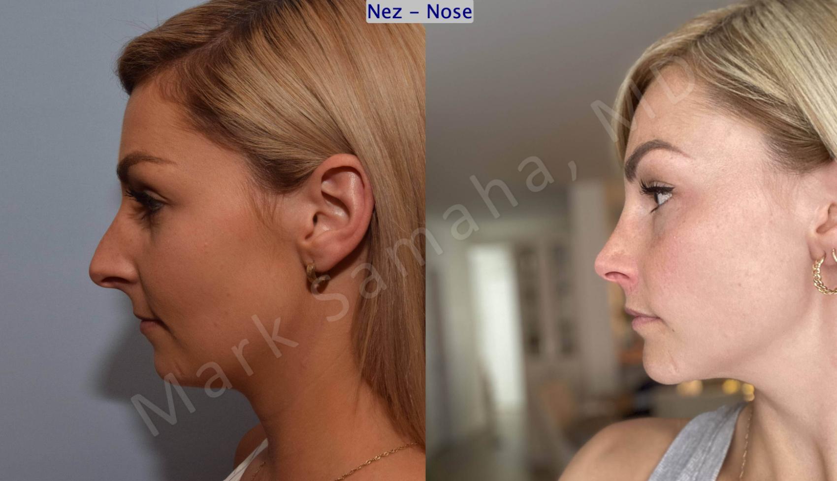 Before & After Rhinoplastie / Rhinoplasty Case 192 Left Side View in Montreal, QC