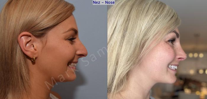 Before & After Rhinoplastie / Rhinoplasty Case 192 Right Side Smile View in Montreal, QC
