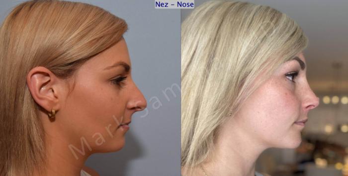 Before & After Rhinoplastie / Rhinoplasty Case 192 Right Side View in Montreal, QC