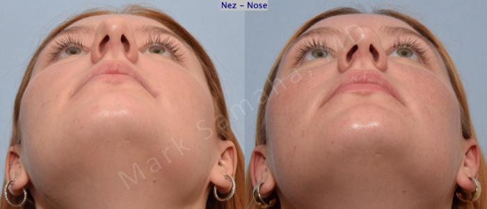 Before & After Rhinoplastie / Rhinoplasty Case 193 Basal View in Mount Royal, QC