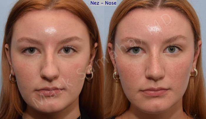 Before & After Rhinoplastie / Rhinoplasty Case 193 Front View in Mount Royal, QC