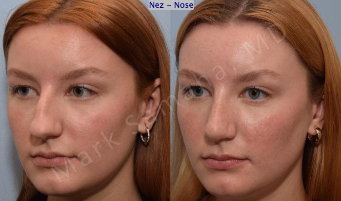 Before & After Rhinoplastie / Rhinoplasty Case 193 Left Oblique View in Montreal, QC