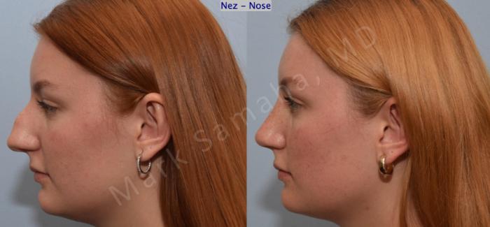 Before & After Rhinoplastie / Rhinoplasty Case 193 Left Side View in Montreal, QC