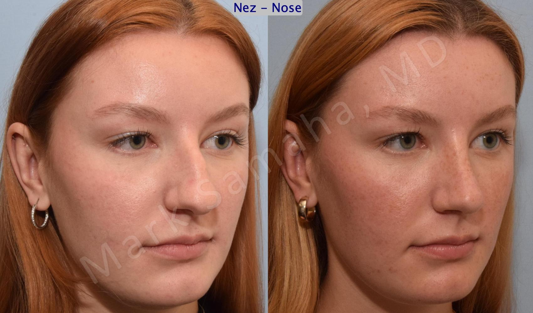 Before & After Rhinoplastie / Rhinoplasty Case 193 Right Oblique View in Mount Royal, QC