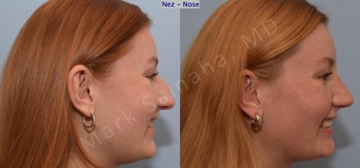 Before & After Rhinoplastie / Rhinoplasty Case 193 Right Side Smile View in Montreal, QC