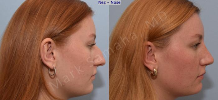 Before & After Rhinoplastie / Rhinoplasty Case 193 Right Side View in Montreal, QC